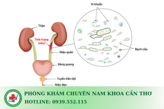 viem-duong-tiet-nieu.png