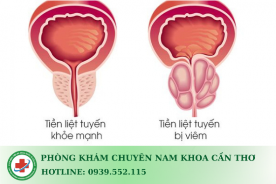 viem-tuyen-tien-liet.png