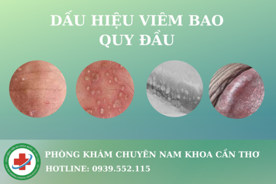 Dau-hieu-cua-viem-bao-quy-dau.png